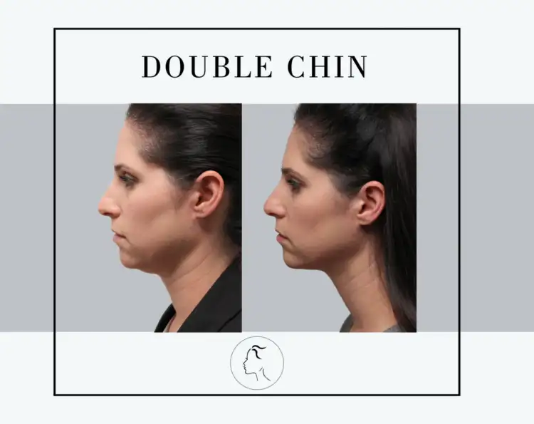 before and after double chin treatment on woman